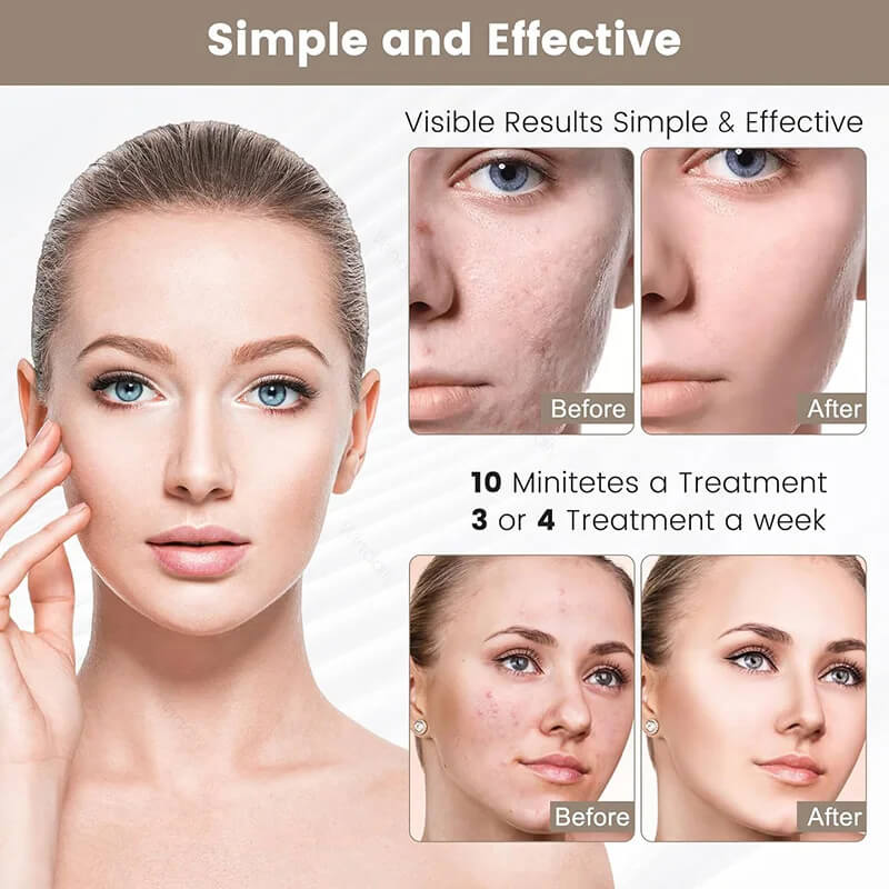 Advertisement for a skincare treatment showing before and after results with text about frequency of treatments.